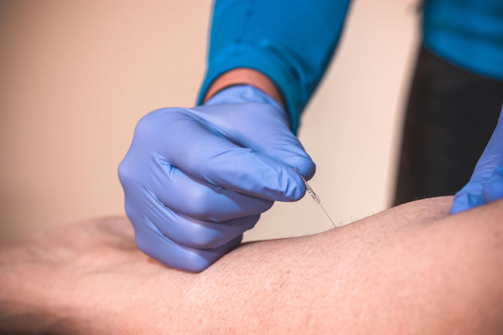 Dry needling of the calf