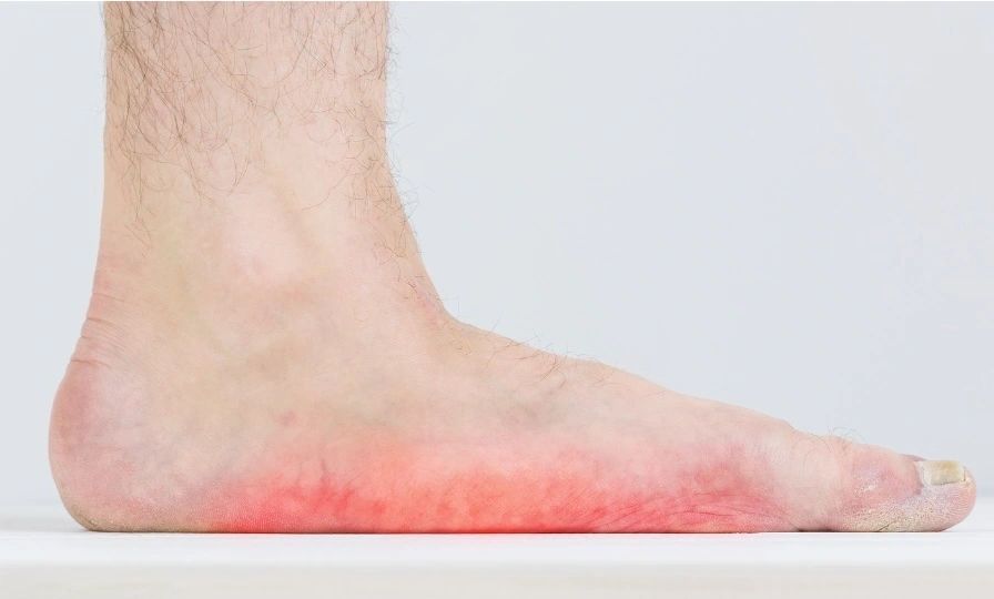 Foot pain due to arch collapse, pes planus, and may need orthotics