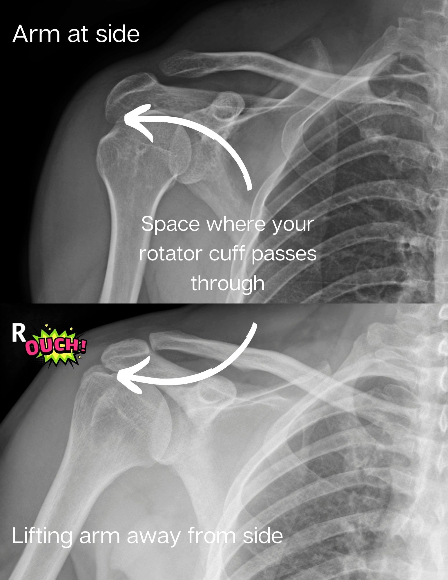 Rotator Cuff Impingement During lifting the arm overhead. Dysfunction of the rotator cuff results in the humerus rising up and pinching the rotator cuff under the acromion of the scapula.